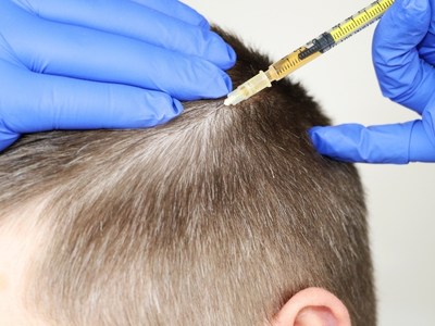 مزوتراپی مو چیست؟